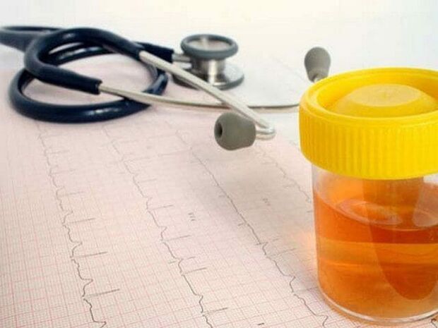 Sistit tanısı için idrar analizi